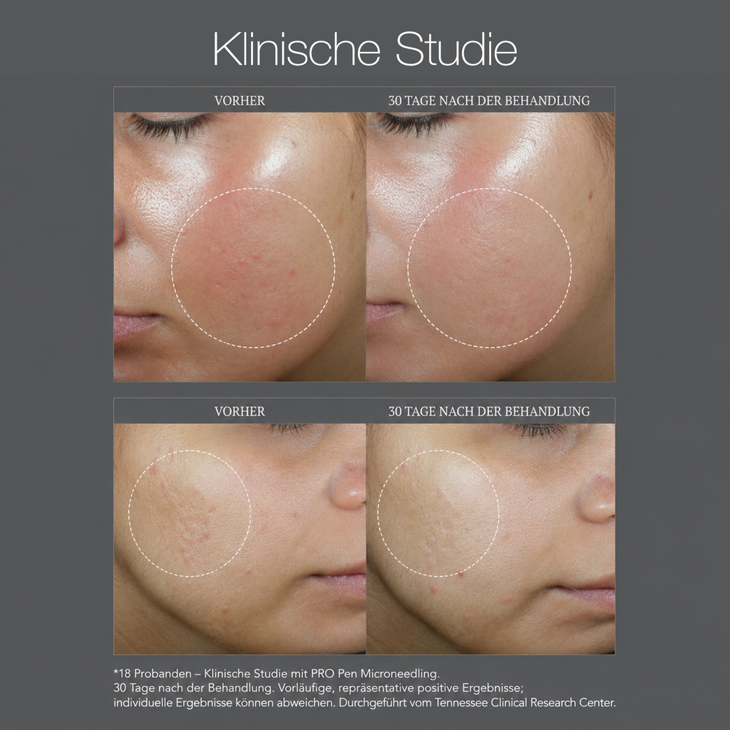Pro Microneedling Pen 2 - Angebot