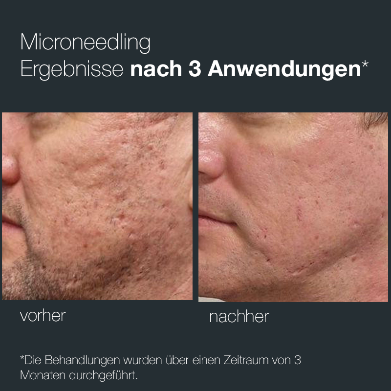 Pro Microneedling Pen 2 - FDA Angebot